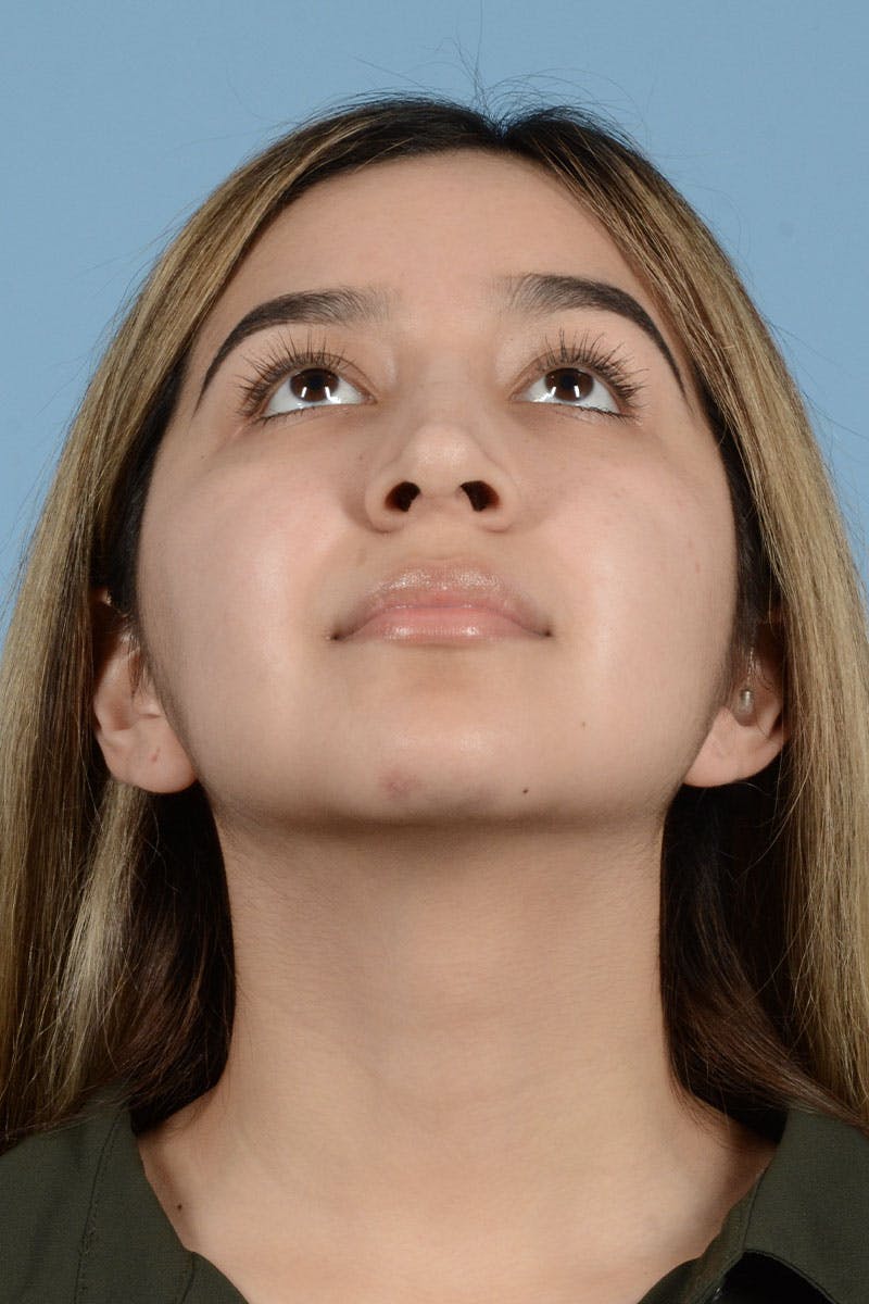 Rhinoplasty Before & After Gallery - Patient 122226555 - Image 8