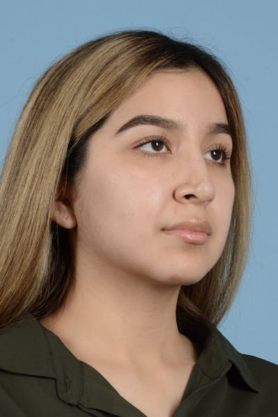 Rhinoplasty Before & After Gallery - Patient 122226555 - Image 10