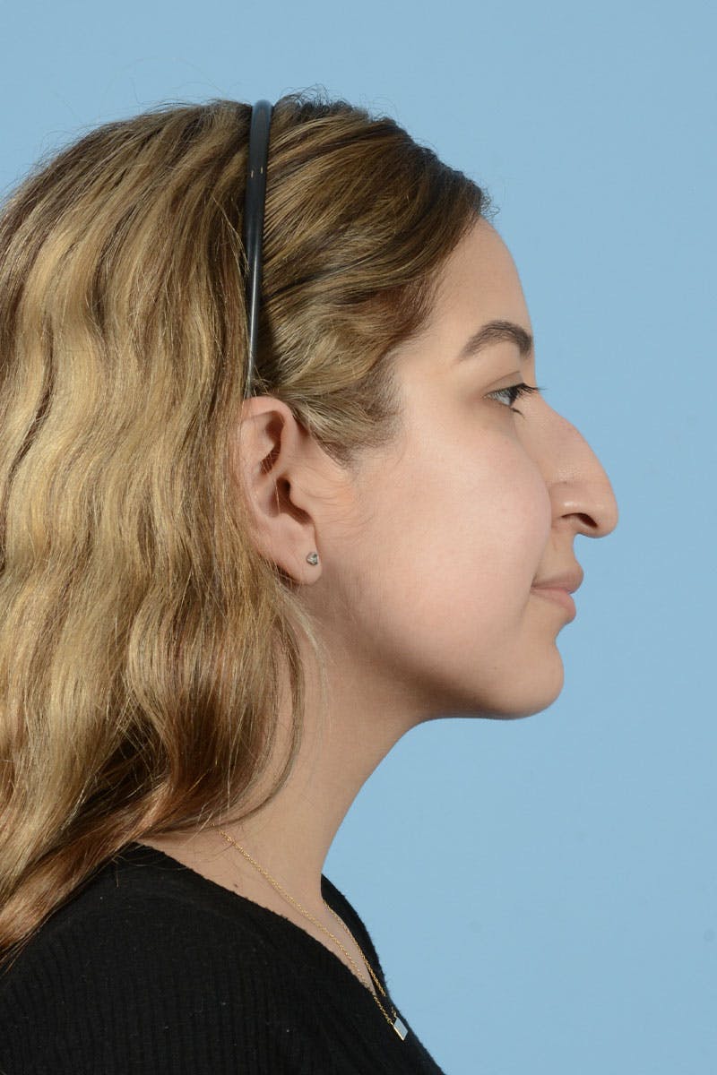 Rhinoplasty Before & After Gallery - Patient 122226555 - Image 11