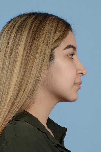 Rhinoplasty Before & After Gallery - Patient 122226555 - Image 12