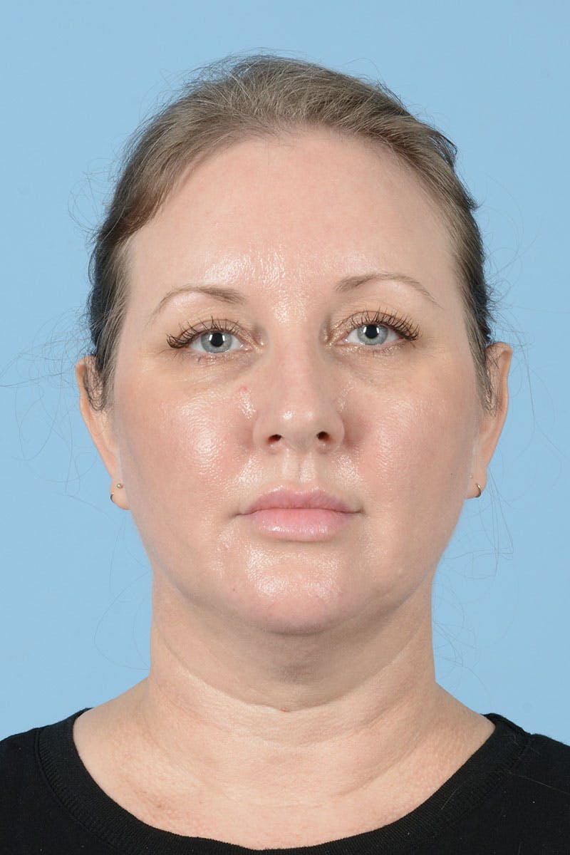 Neck Lift Before & After Gallery - Patient 122226569 - Image 1