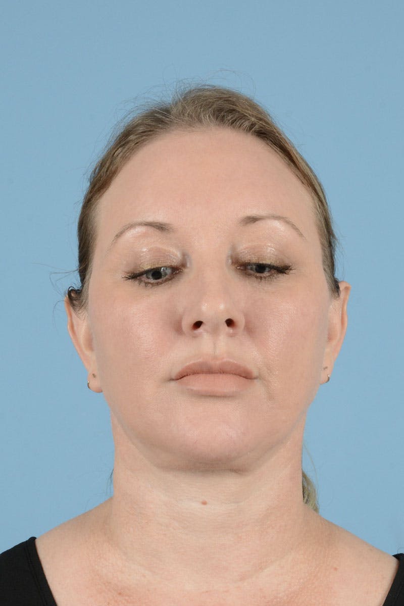 Neck Lift Before & After Gallery - Patient 122226569 - Image 4