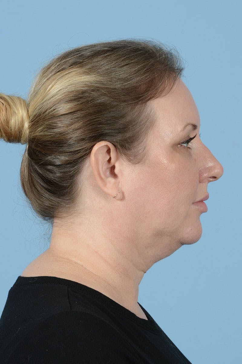 Neck Lift Before & After Gallery - Patient 122226569 - Image 7
