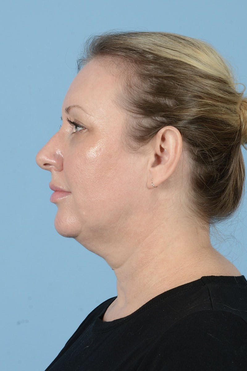 Facelift Before & After Gallery - Patient 122226567 - Image 11