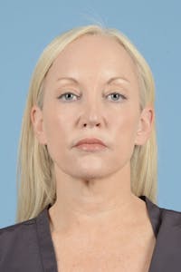 Facelift Before & After Gallery - Patient 122226574 - Image 1
