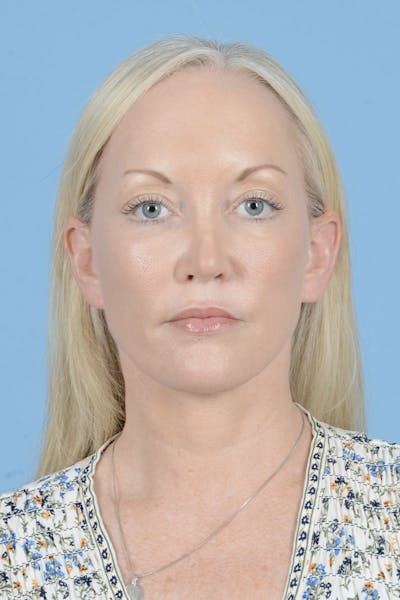 Facelift Before & After Gallery - Patient 122226574 - Image 2