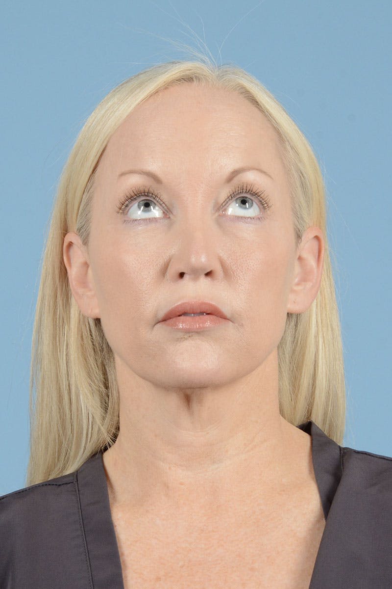 Facelift Before & After Gallery - Patient 122226574 - Image 3