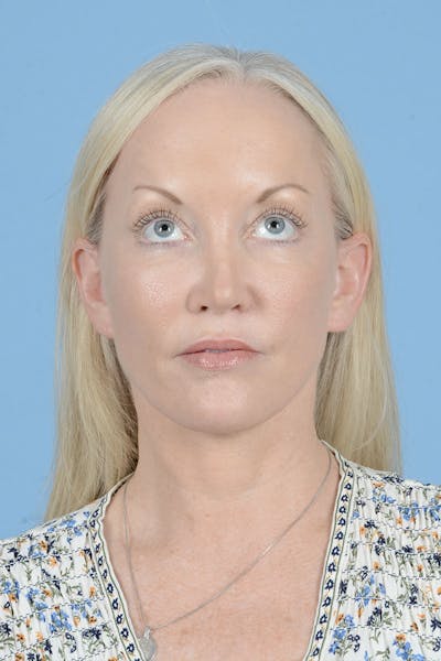 Facelift Before & After Gallery - Patient 122226574 - Image 4