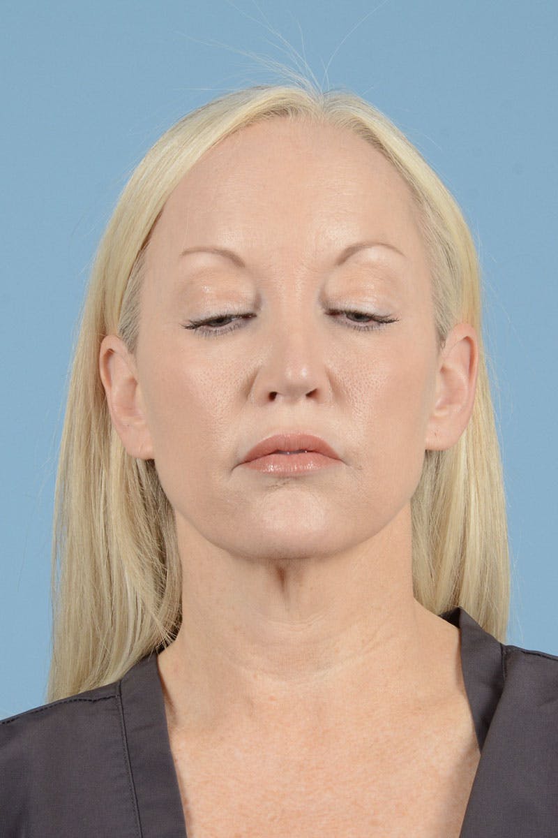 Neck Lift Before & After Gallery - Patient 122226573 - Image 5