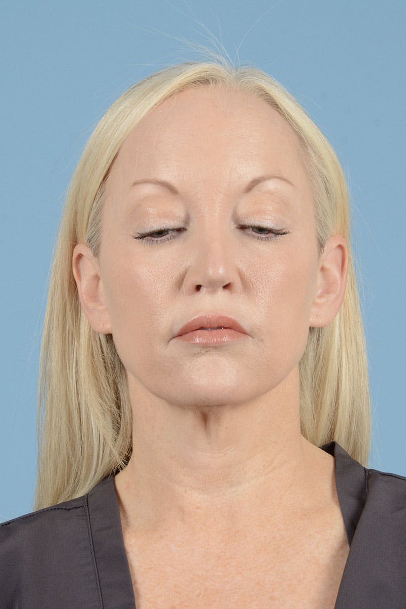 Facelift Before & After Gallery - Patient 122226574 - Image 5