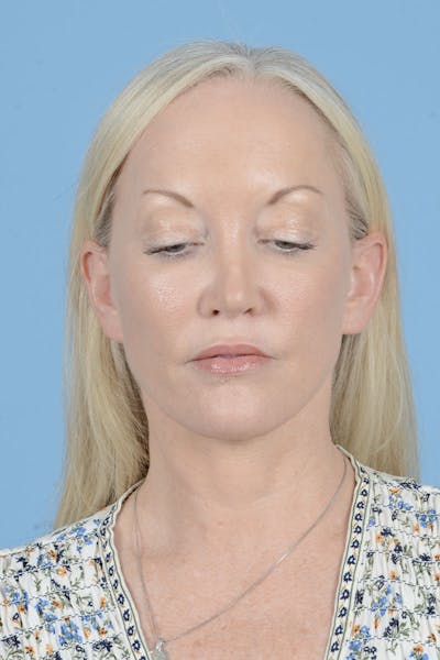 Facelift Before & After Gallery - Patient 122226574 - Image 6