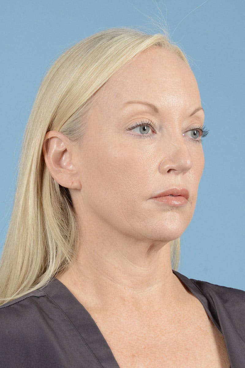 Facelift Before & After Gallery - Patient 122226574 - Image 7