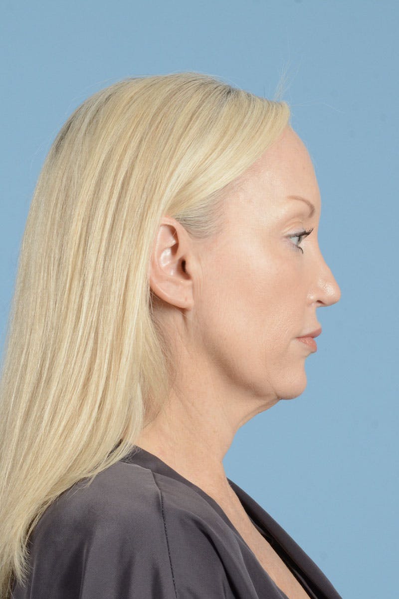 Facelift Before & After Gallery - Patient 122226574 - Image 9