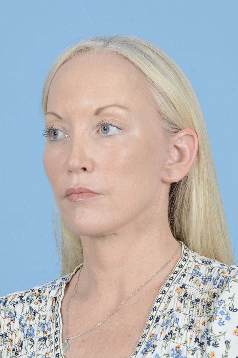 Facelift Before & After Gallery - Patient 122226574 - Image 12