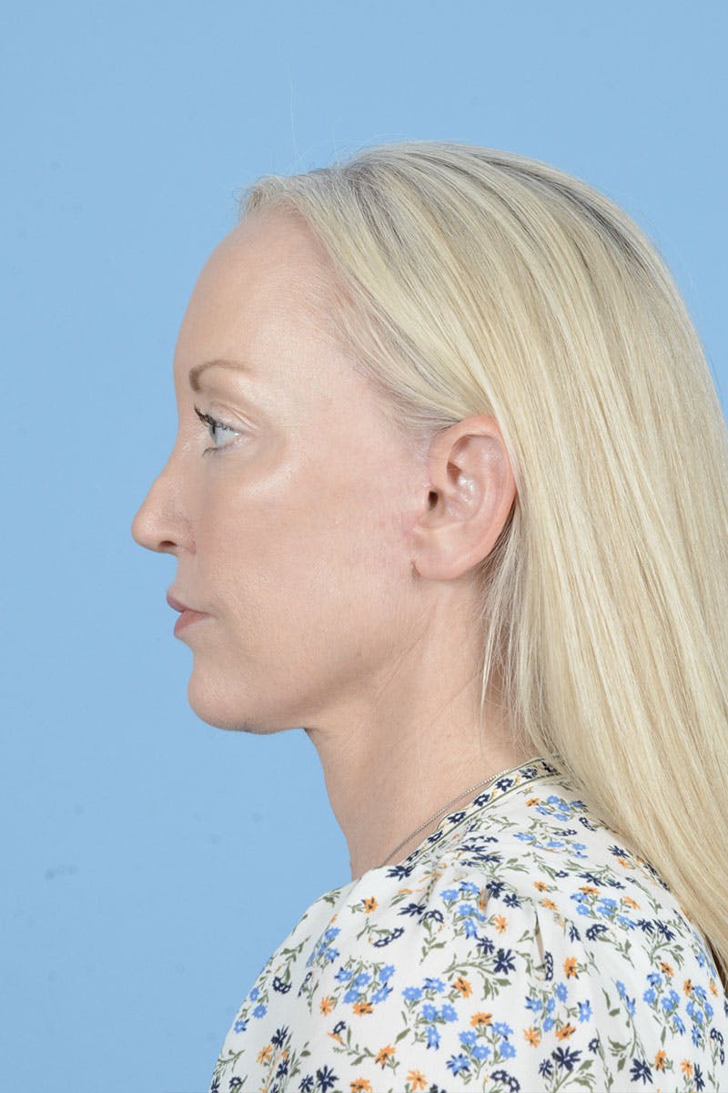 Neck Lift Before & After Gallery - Patient 122226573 - Image 14