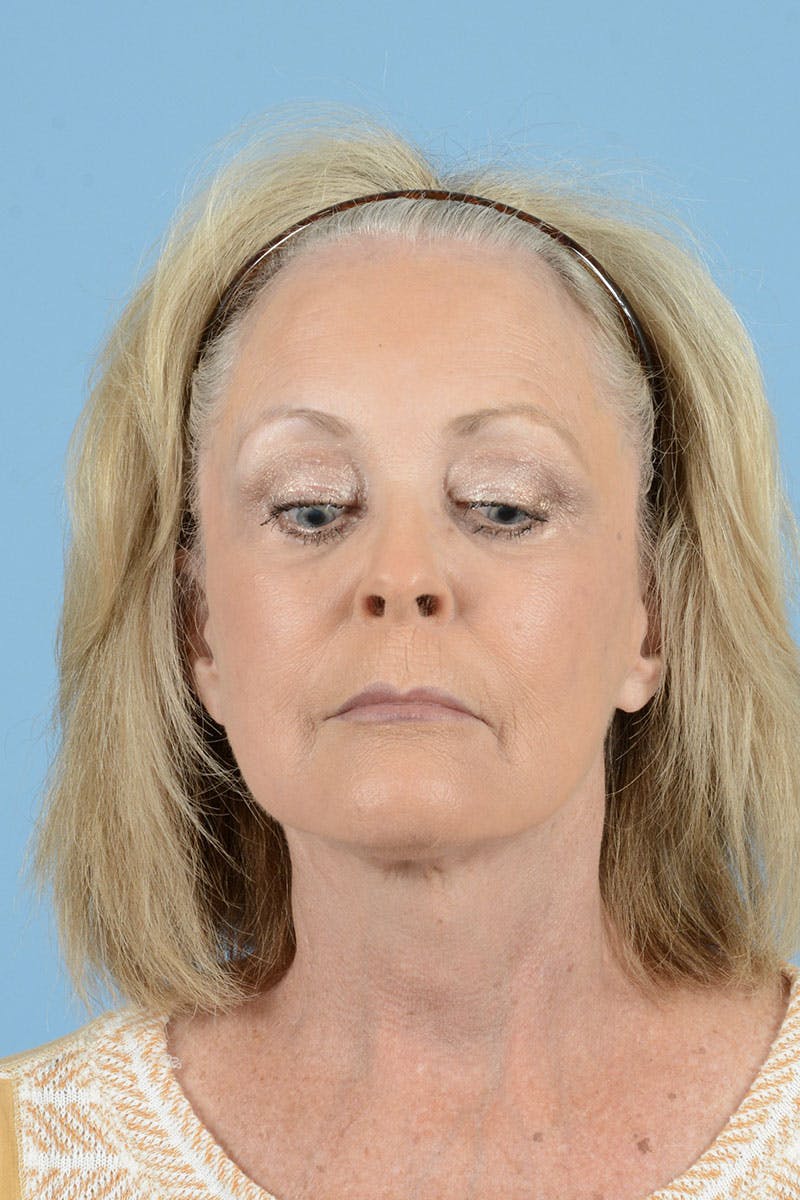 Facelift Before & After Gallery - Patient 122226587 - Image 4