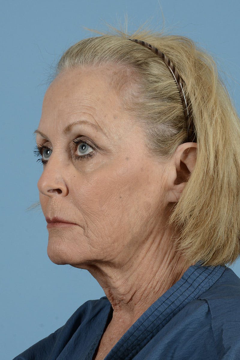 Facelift Before & After Gallery - Patient 122226587 - Image 7