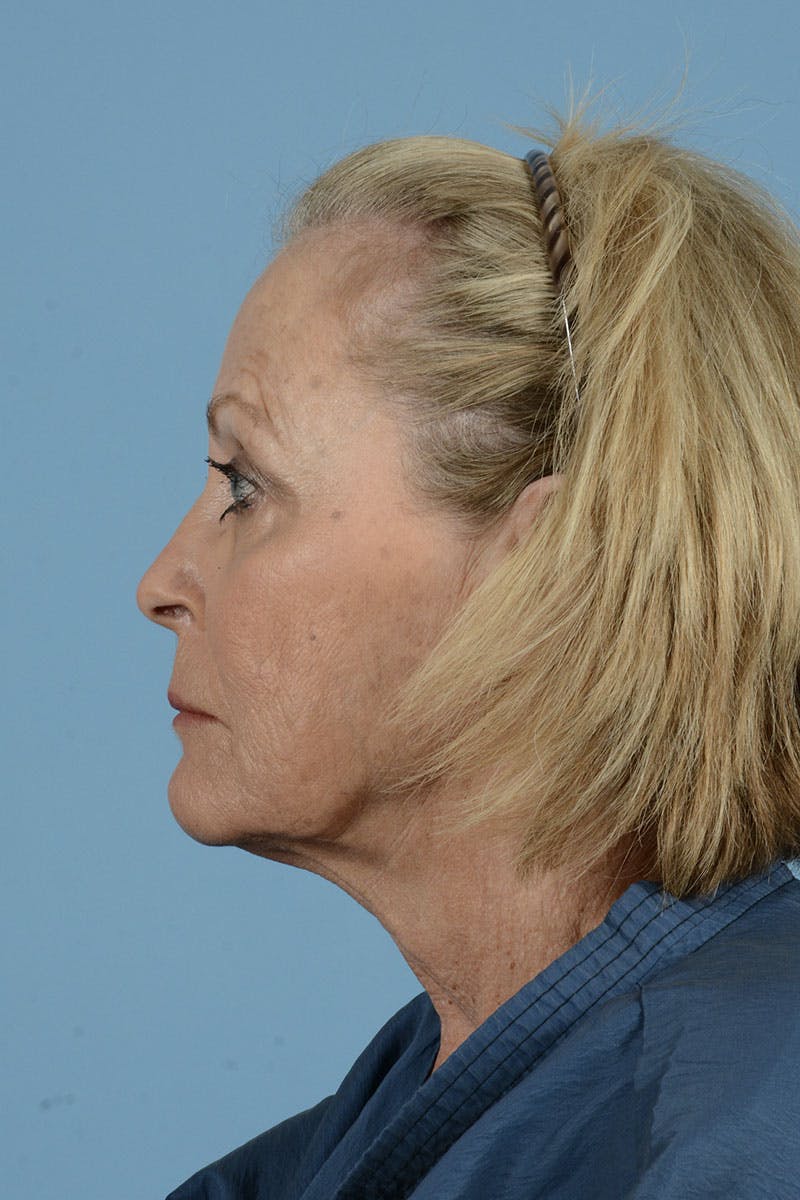 Neck Lift Before & After Gallery - Patient 122226615 - Image 9