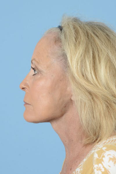 Brow Lift Before & After Gallery - Patient 122226576 - Image 10