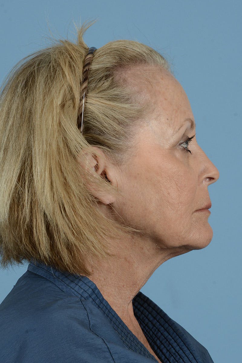 Neck Lift Before & After Gallery - Patient 122226615 - Image 13