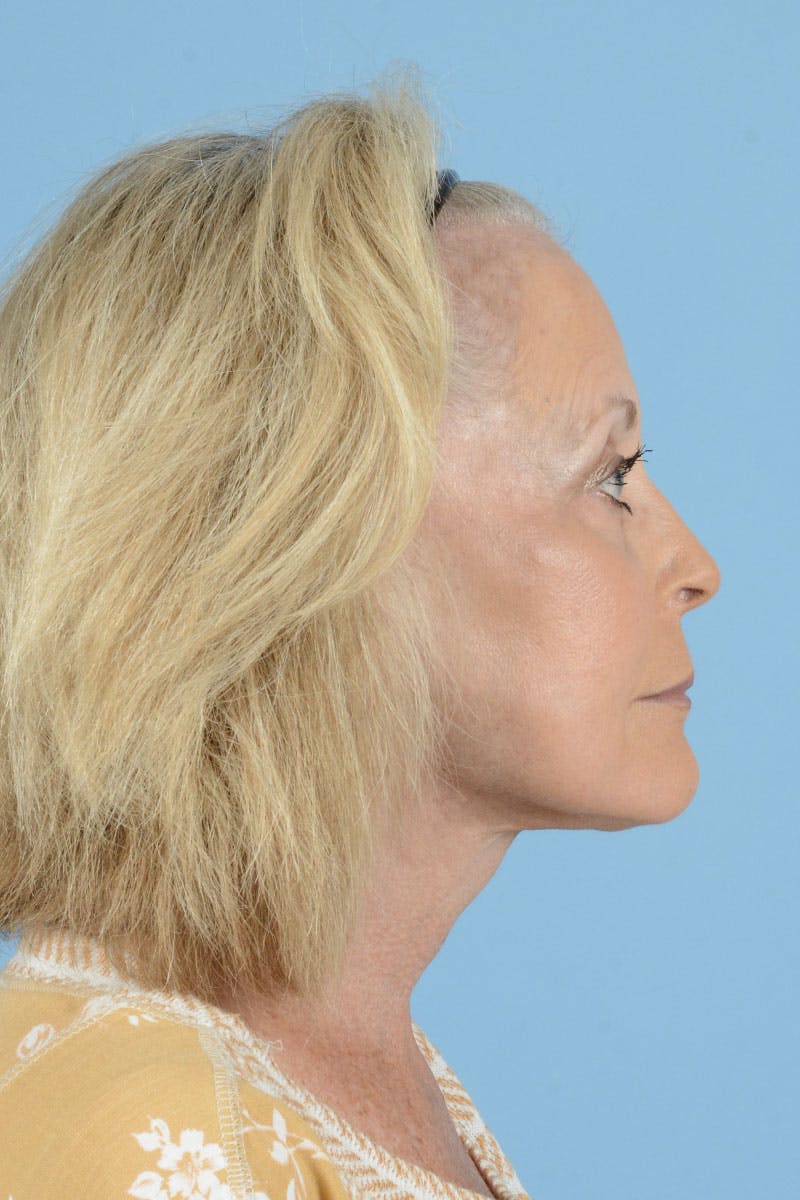 Neck Lift Before & After Gallery - Patient 122226615 - Image 14