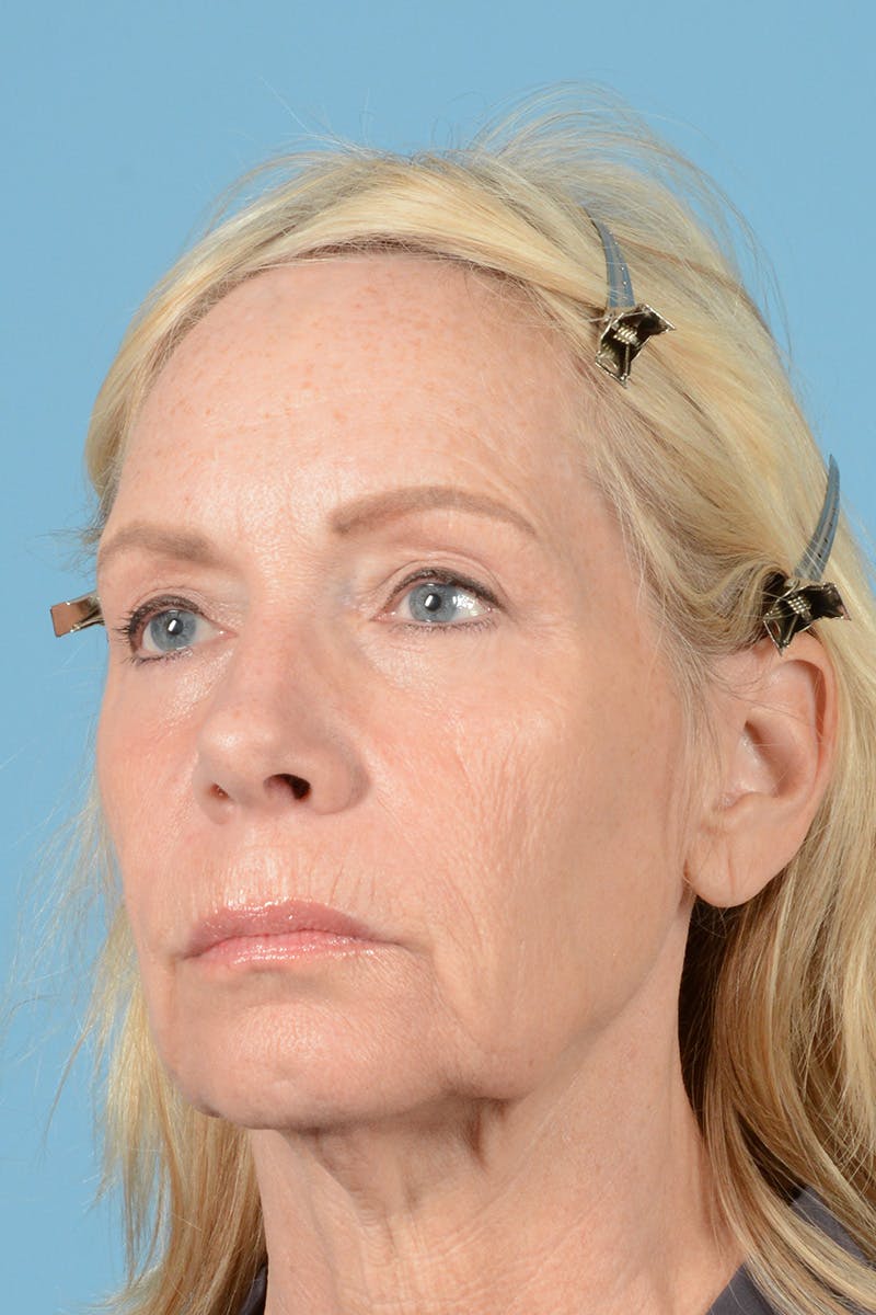 Facelift Before & After Gallery - Patient 144554605 - Image 7