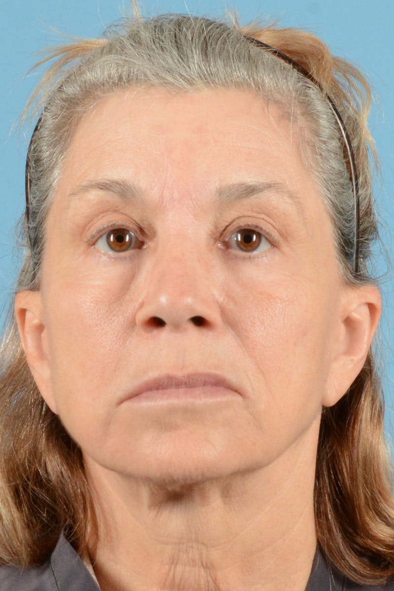 Facelift Before & After Gallery - Patient 144554608 - Image 1