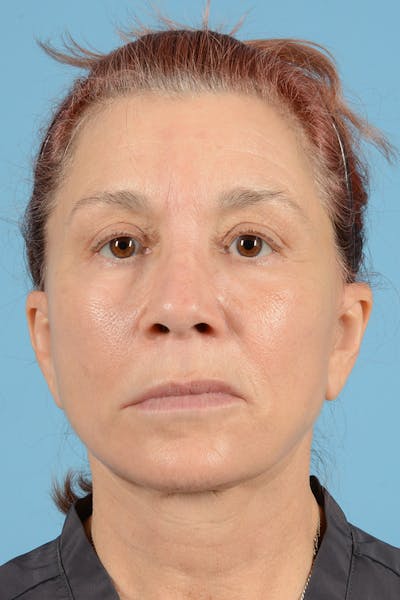 Facelift Before & After Gallery - Patient 144554608 - Image 2