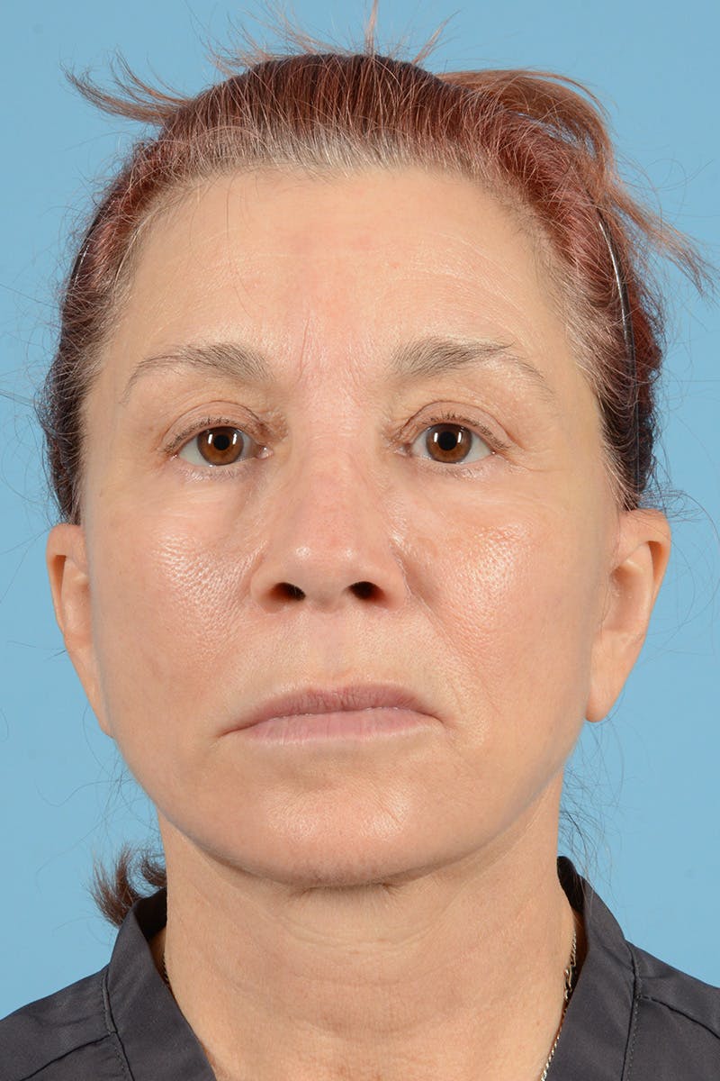 Facelift Before & After Gallery - Patient 144554608 - Image 2