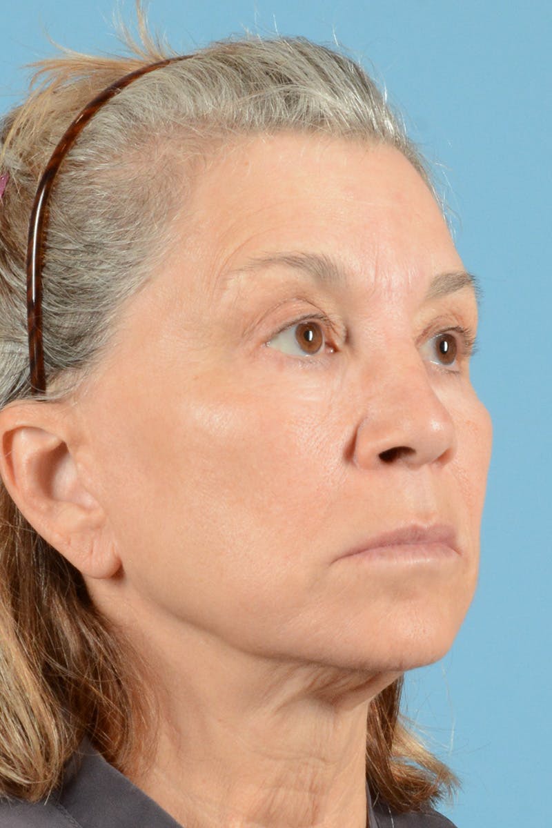 Facelift Before & After Gallery - Patient 144554608 - Image 3