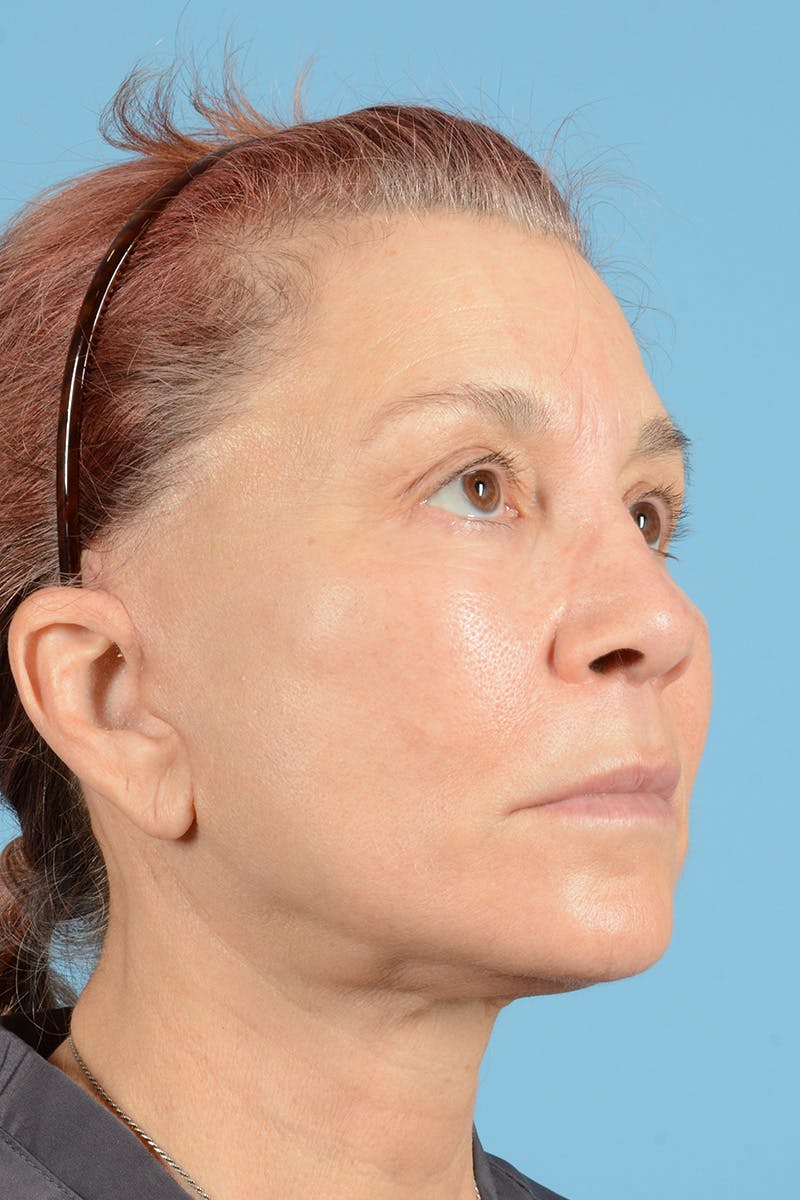 Facelift Before & After Gallery - Patient 144554608 - Image 4