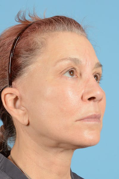 Facelift Before & After Gallery - Patient 144554608 - Image 4
