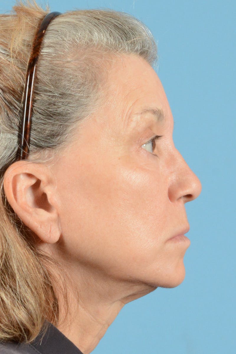 Facelift Before & After Gallery - Patient 144554608 - Image 5