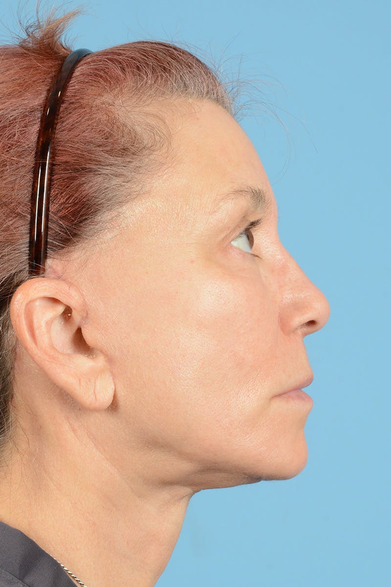 Facelift Before & After Gallery - Patient 144554608 - Image 6