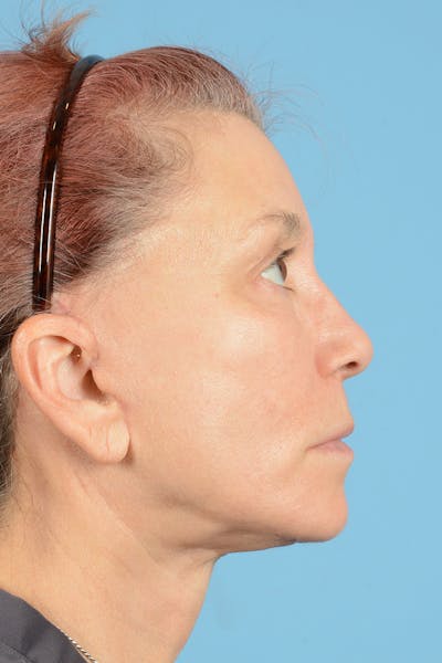 Facelift Before & After Gallery - Patient 144554608 - Image 6