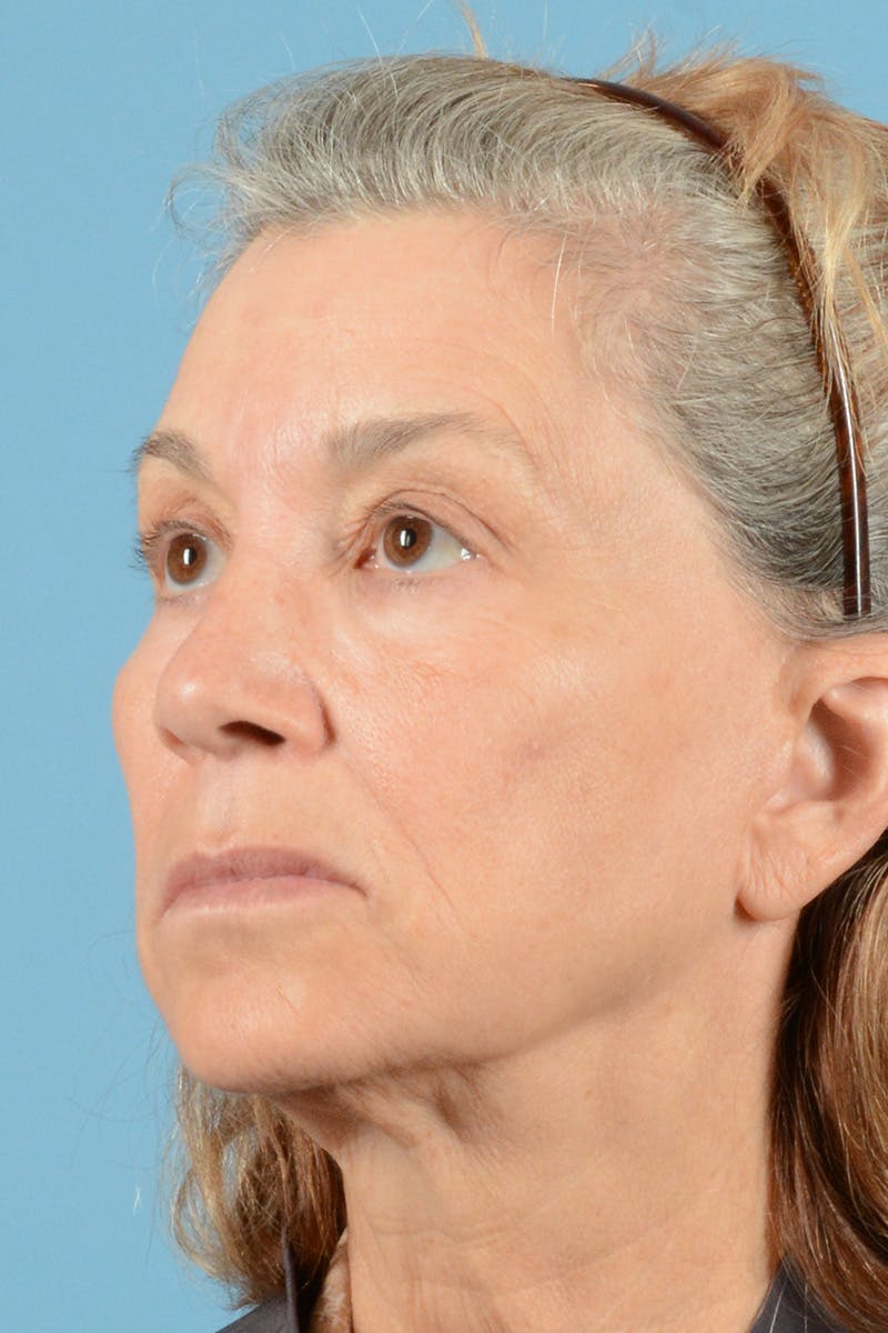 Facelift Before & After Gallery - Patient 144554608 - Image 7