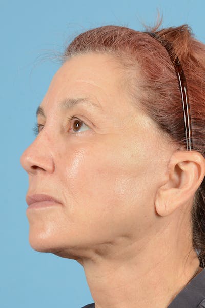 Facelift Before & After Gallery - Patient 144554608 - Image 8
