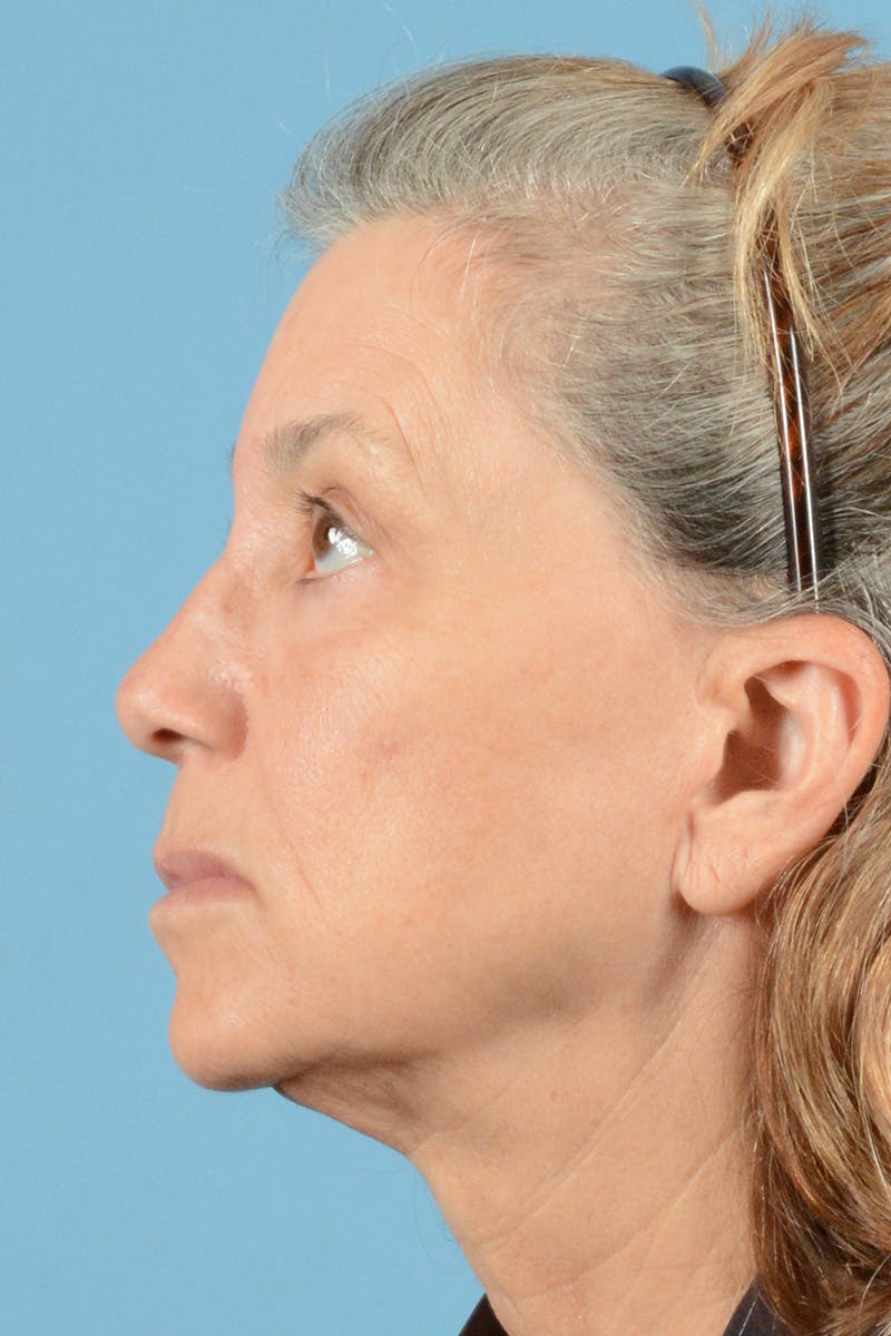 Facelift Before & After Gallery - Patient 144554608 - Image 9