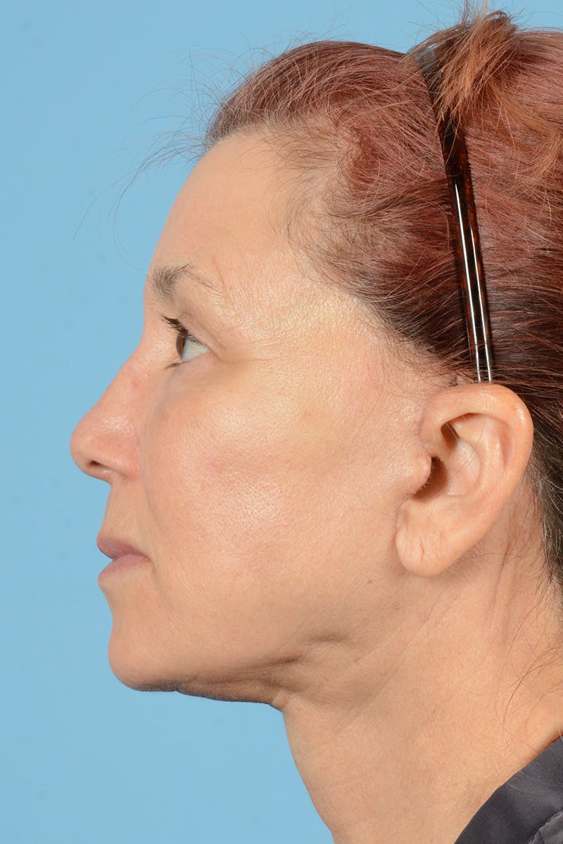 Facelift Before & After Gallery - Patient 144554608 - Image 10