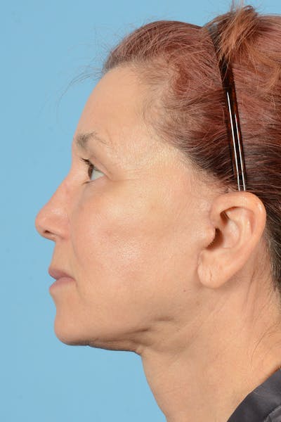 Facelift Before & After Gallery - Patient 144554608 - Image 10