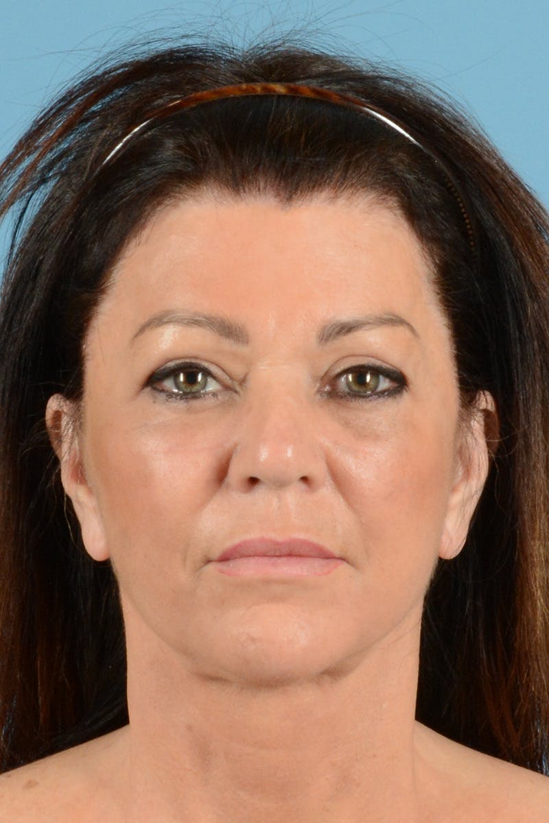 Facelift Before & After Gallery - Patient 144554620 - Image 2