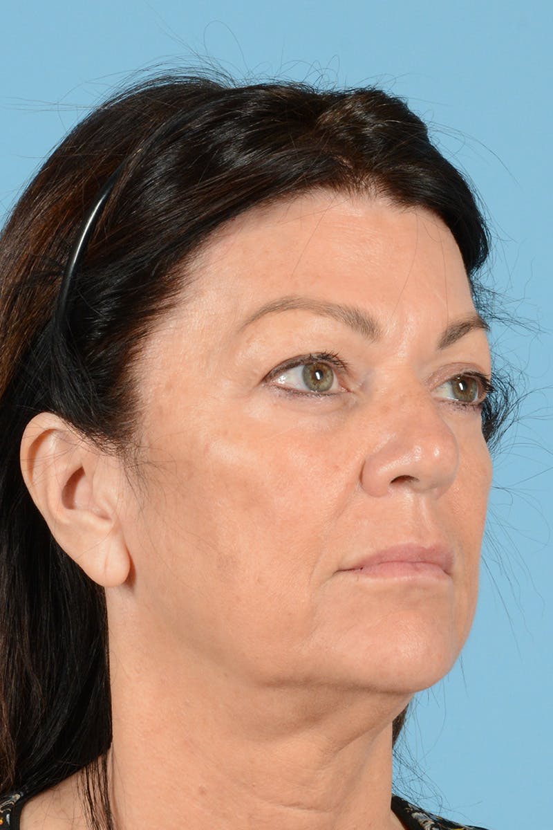 Facelift Before & After Gallery - Patient 144554620 - Image 3
