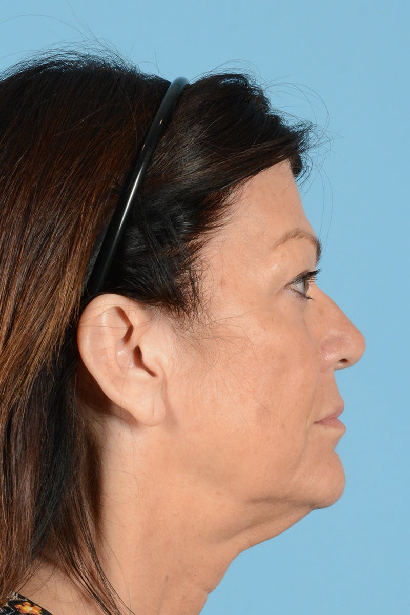 Facelift Before & After Gallery - Patient 144554620 - Image 5