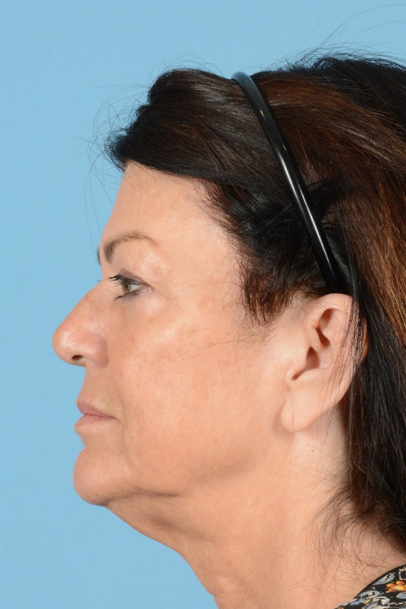 Facelift Before & After Gallery - Patient 144554620 - Image 9