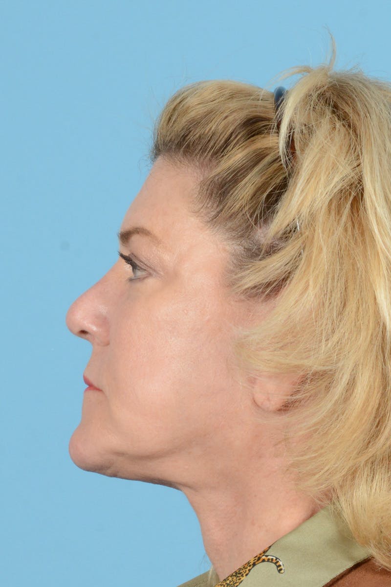 Facelift Before & After Gallery - Patient 144554625 - Image 6