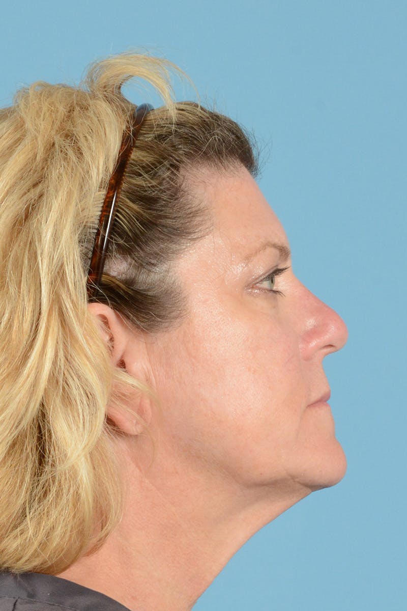 Facelift Before & After Gallery - Patient 144554625 - Image 7