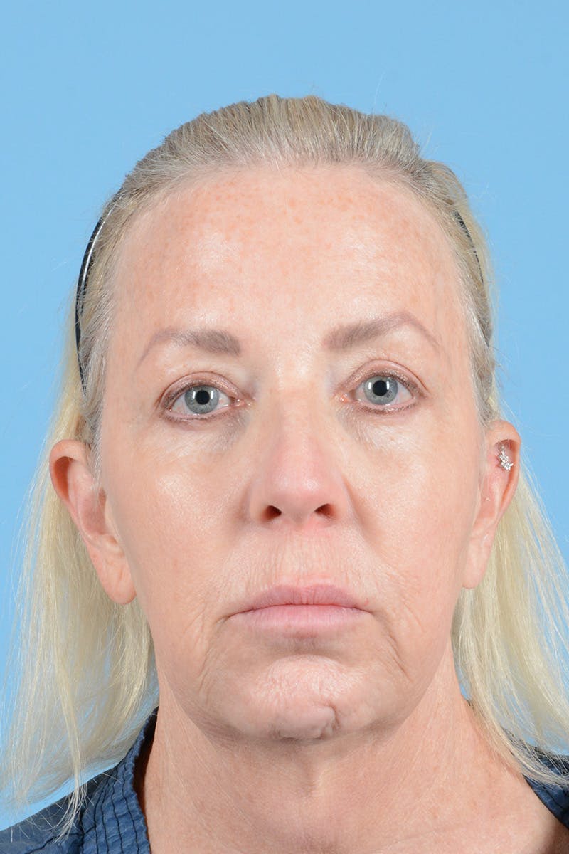 Facelift Before & After Gallery - Patient 144554629 - Image 1