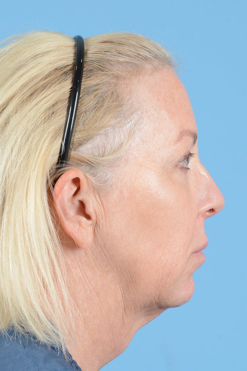 Facelift Before & After Gallery - Patient 144554629 - Image 5
