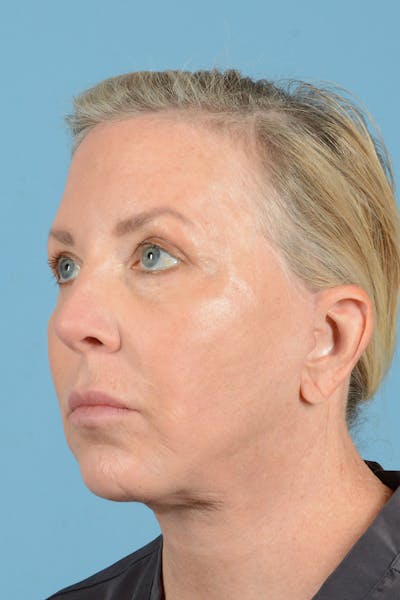 Facelift Before & After Gallery - Patient 144554629 - Image 8