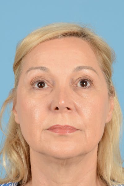 Facelift Before & After Gallery - Patient 144554632 - Image 1